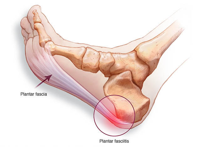 foot diagram howing plantar fascia and fasciitis