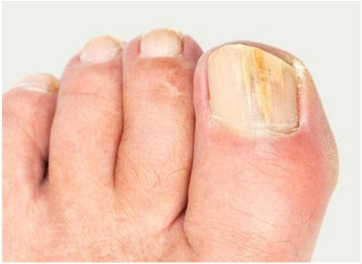 TOENAIL PROBLEMS